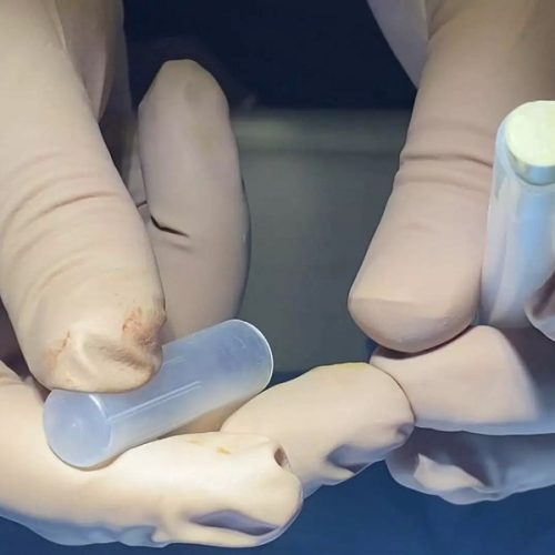 Naltrexone Implant Finally Available for Americans